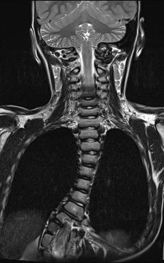 Figure 3: MRI appearance of a type 1 Diastematomyelia.