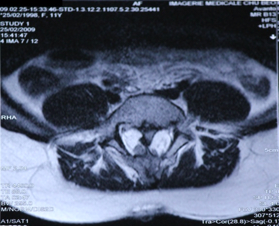 Figure 4: Peroperative appearance of a bone spur after its ablation