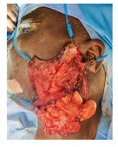 Figure 3: Axial MR image showing a large lipoma involving parotid, submandibular and parapharyngeal spaces.