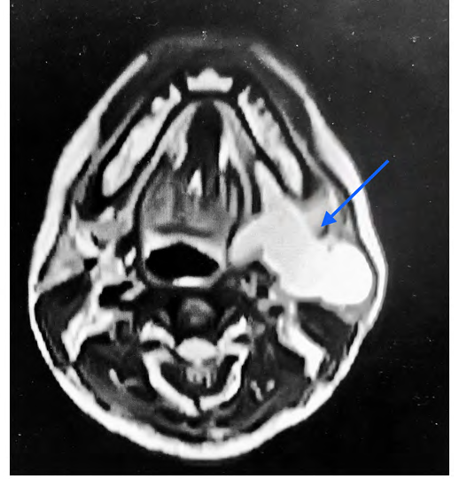 Figure 4: Surgical excision of the lipoma via Transparotid/ Submandibular approach.
