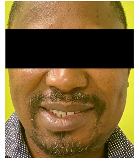 Figure 5: Two-weeks follow-up of the patient showing mild left marginal mandibular nerve weakness.