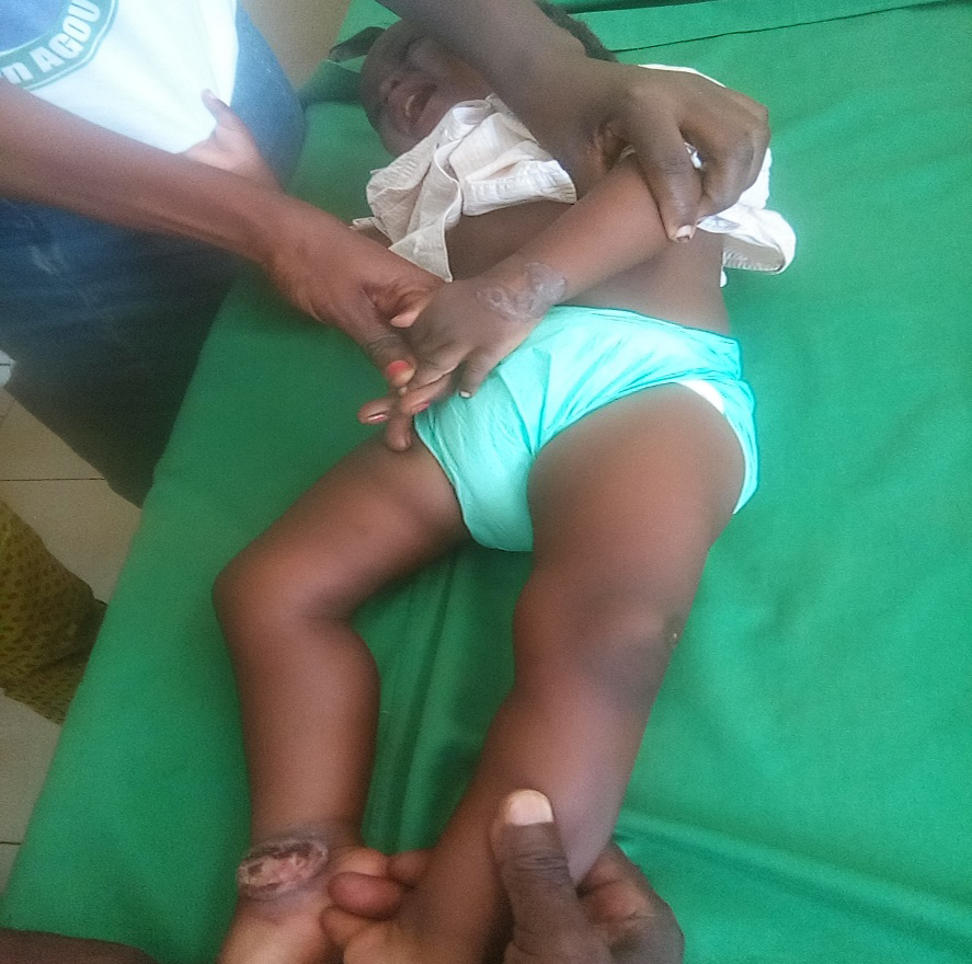 Figure 1: Image of the first case of leishmaniasis in an infant observed in Bangui, 2020.