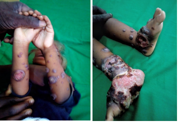 Figure 3: Aggravation of leishmaniasis lesions in an infant in Bangui, 2021.