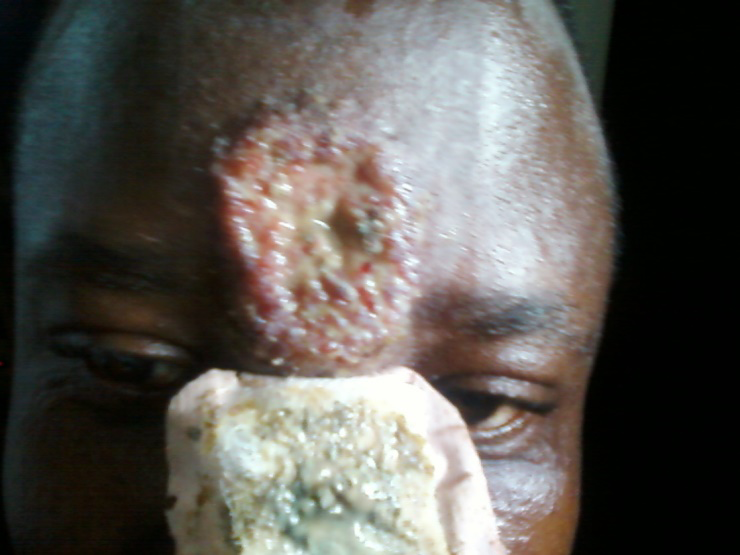 Figure 4: Image of leishmaniasis in a 35-year-old adult from Birao, North East Central African Republique in 2005.