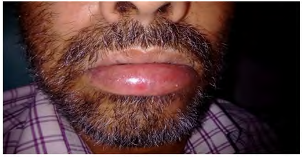 Figure 2: Extraoral image showing diffuse swelling of lower lip.