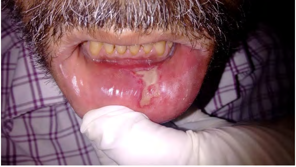 Figure 3: Intraoral image showing well defined non- healing ulcer in lower lip.