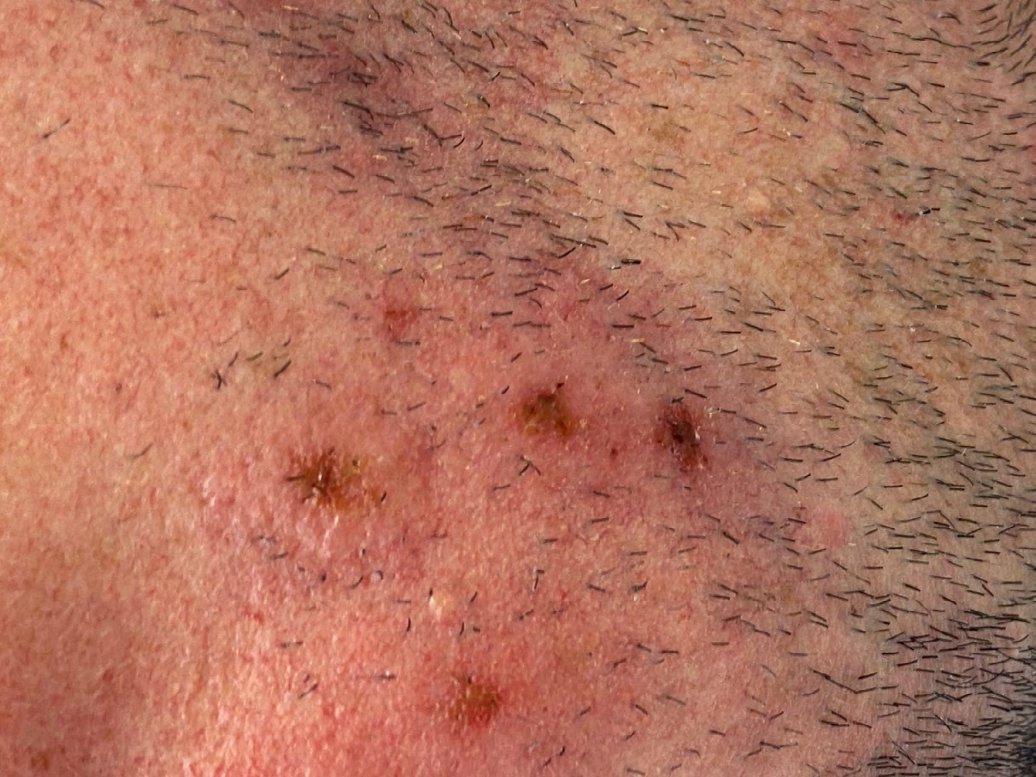 Figure 3: Crusted lesions in the beard.