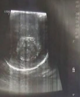 Figure 2: A haematoma-related echogenic collection on a penile ultrasonography.