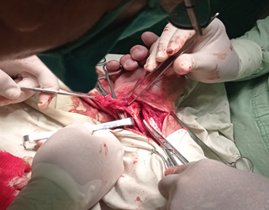 Figure 1: Surgical incision, slightly wider than normal, showing hypertrophy and coloration of the synovium.