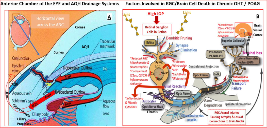 Figure 1: The AQH production and egress from ANC of eye, and the factors that kill RGCs /RGC axons in chronic OHT/POAG.
