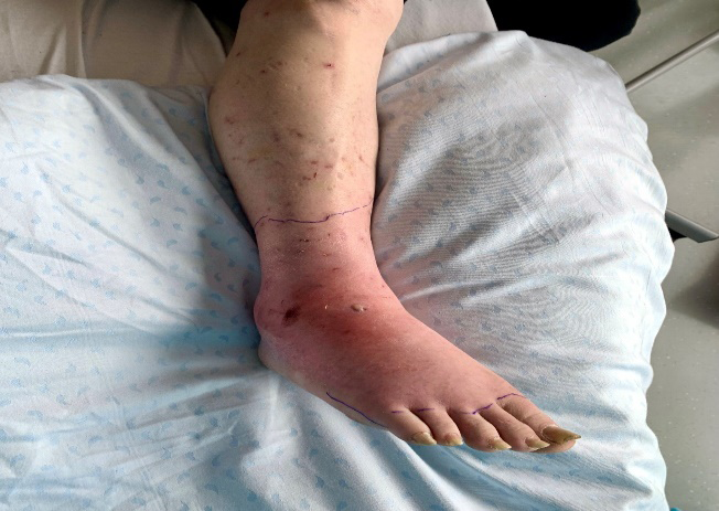 Figure 1: Erythematous induration of the right foot and atrophic scars on the leg.