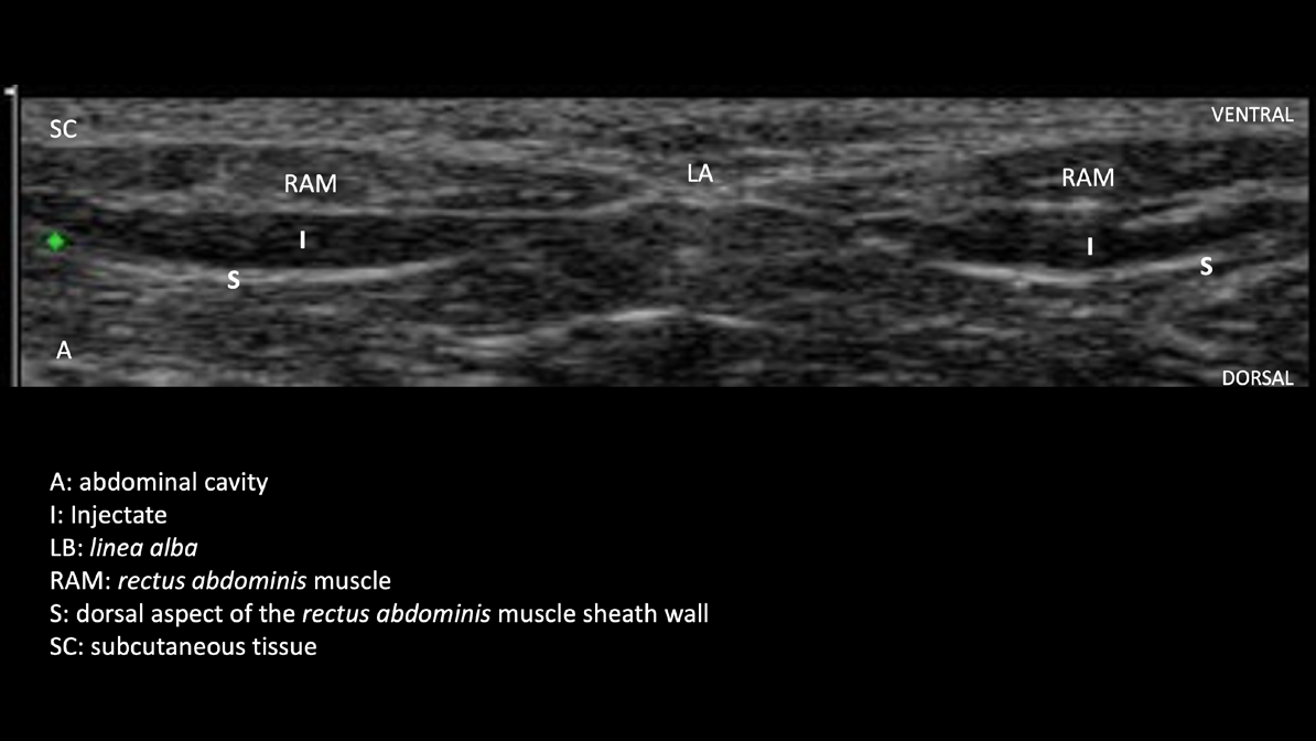 Figure 1: Ultrasound image (transverse section) of the abdominal wall after the successful performance of the RSB: bilateral anechoic areas in the sheath dorsally to the muscle and ventrally to the peritoneum (A: abdominal cavity, I: Injectate, LB: linea alba, RAM: rectus abdominis muscle, S: dorsal aspect of the rectus abdominis muscle sheath wall, SC: subcutaneous tissue).