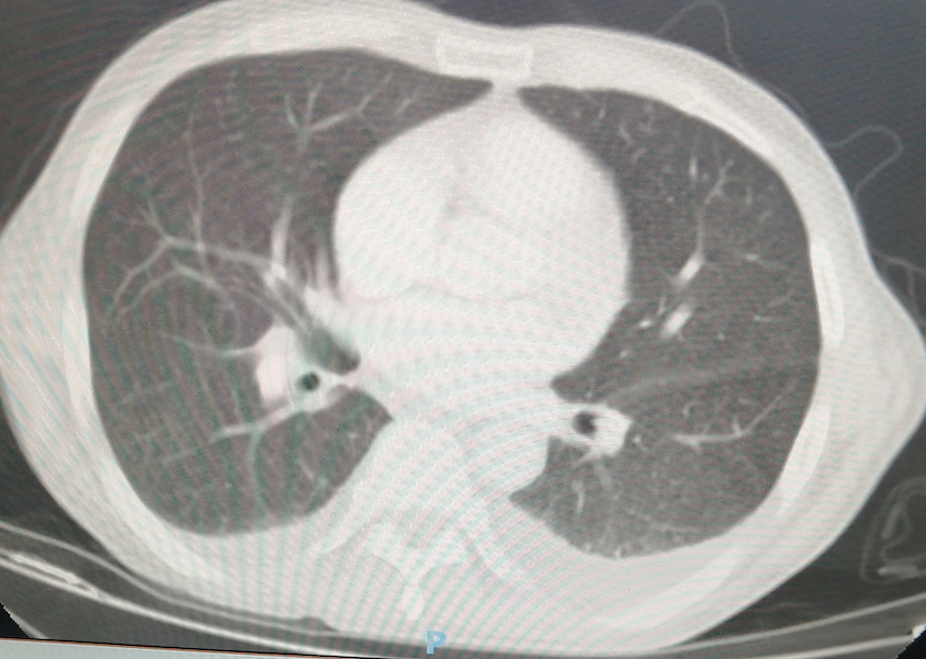 Figure 1: Simple chest CT scan in pulmonary phase showing calcified granuloma in the middle segment of the right lower lobe.