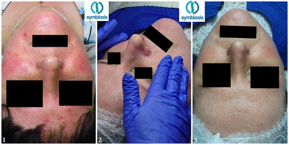 Figure 2: The effects of the procedure of in-office treatments (zero test, tests after 2 and 6 weeks) and home care.