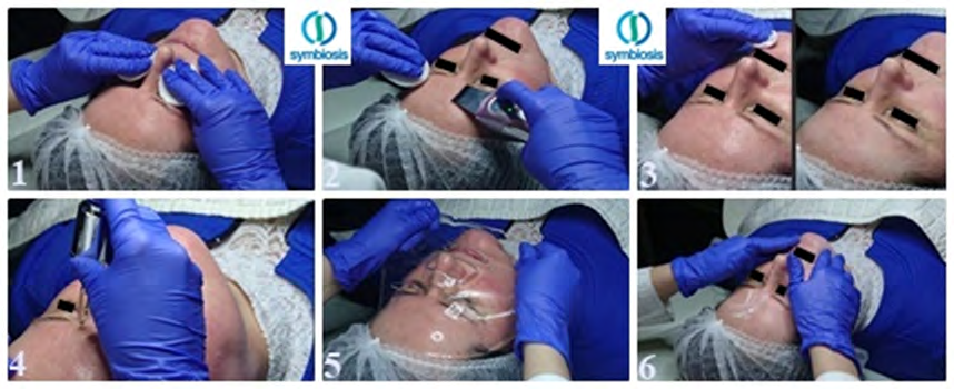 Figure 3: Scheme of the cleansing method by exfoliation in Demodex infection.