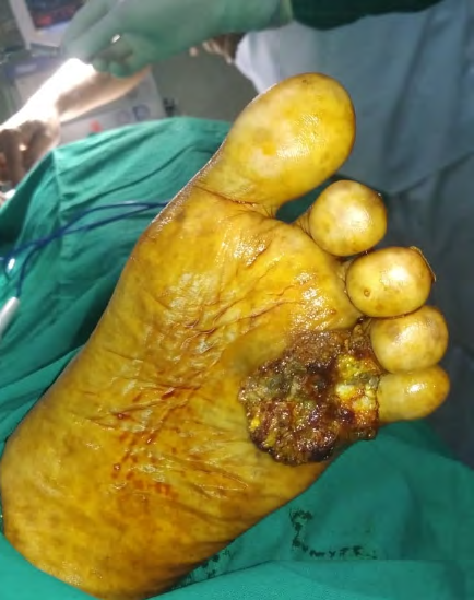 Figure 1: Clinical photo of the lesion in plantar aspect of foot.