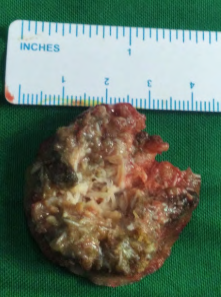 Figure 2: Complete excision of the lesion en masse.