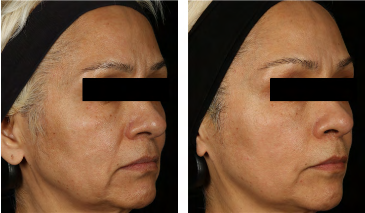 Figure 2: Digital Image of a subject with representative results, demonstrating the visible benefits achievable. Baseline and week 8, side profile.