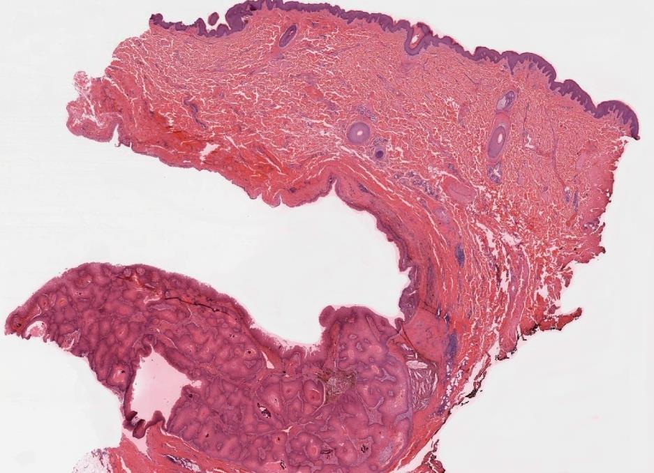 Figure 2: H&E, 20x. Low power view shows a well-circumscribed dermal neoplasm with no connection to the overlying epidermis and a pushing boarder.