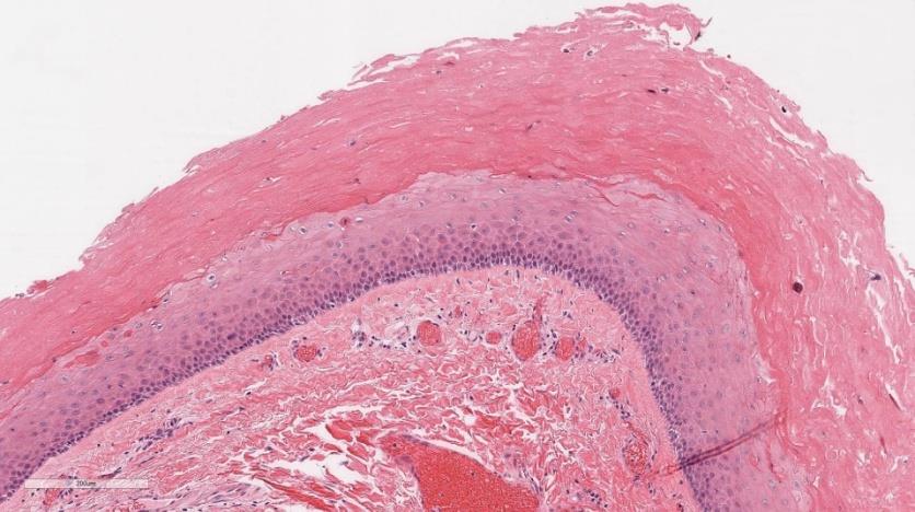 Figure 3: H&E, 200x. High power view shows a portion of the cyst wall, lined by stratified squamous epithelium devoid of a granular layer with peripheral palisading and trichilemmal-type keratinization.