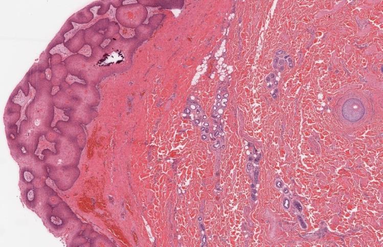 Figure 4: H&E, 200x. High power view shows the solid component, which consists of interanastomosing lobules of squamous epithelium devoid of a granular layer with foci of trichilemmal-type keratinization.