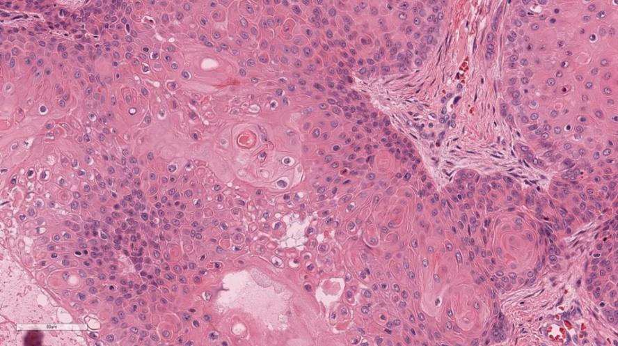Figure 5: H&E, 400x. High power view shows no significant cytologic atypia, necrosis, atypical mitoses,