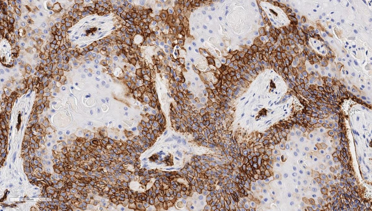 Figure 6: CD34, 400x. High power view shows positive membrane staining with normal vascular