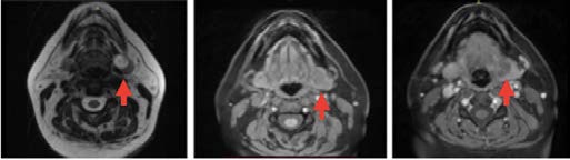 Figure 1: Neck MRI a) T2 image; b) T1 vol; c) T1 vol post contrast.