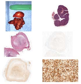 Figure 2: a) surgical speciment; b) Photomicrograph of histological section, stained with hematoxylin eosin (HE), demonstrating an image at 100x magnification of the encircled salivary gland, devoid of significant histological alterations. Image shows normal structure of serous salivary gland, containing acini distributed in lobules, with ducts showing usual distribution, between and within the lobules; c) Photomicrograph of histological section, stained with Hematoxylin Eosin (HE), demonstrating an image at 100x magnification of a nodular structure, which presents a capsule with defined limits. The structure content has a dense fibrillar component containing areas of loose pattern of this component. (Antoni A and Antoni B areas); d) Photomicrograph of histological section, used in Immunohistochemical Examination (Anti-Ki-67 Protein Antibody), demonstrating a 100x magnification image of a nodular structure, showing negativity to the exam; e) Photomicrograph of histological section, used in Immunohistochemical Examination (S-100 Anti-Protein Antibody), demonstrating a 100x magnification image of a nodular structure, showing diffuse positivity on examination; f) Photomicrograph of histological section, used in Immunohistochemical Examination (Anti Vimentin Antibody), demonstrating an image at 800 times magnification of nodular structure, showing diffuse positivity to the exam.
