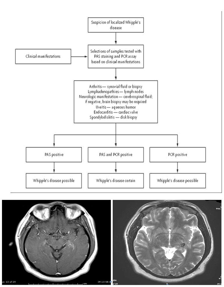 Figure 4: Brain biopsy revealed (+) Periodic acid-Schiff reagent (PAS) intracytoplasmic organisms within multiple macrophages.