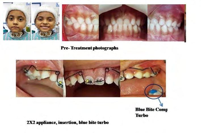 Figure 1: The Lateral cephalometric analysis data is illustrated in table 1, and revealed a , SNA 78.50, SNB 790.ANB -.5, Li-NA 27/5mm, Li-NB 23/6.5 mm. Upper lip -2 mm, and lower lip 4 mm.