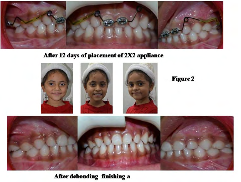 Figure 3: After debonding finishing.