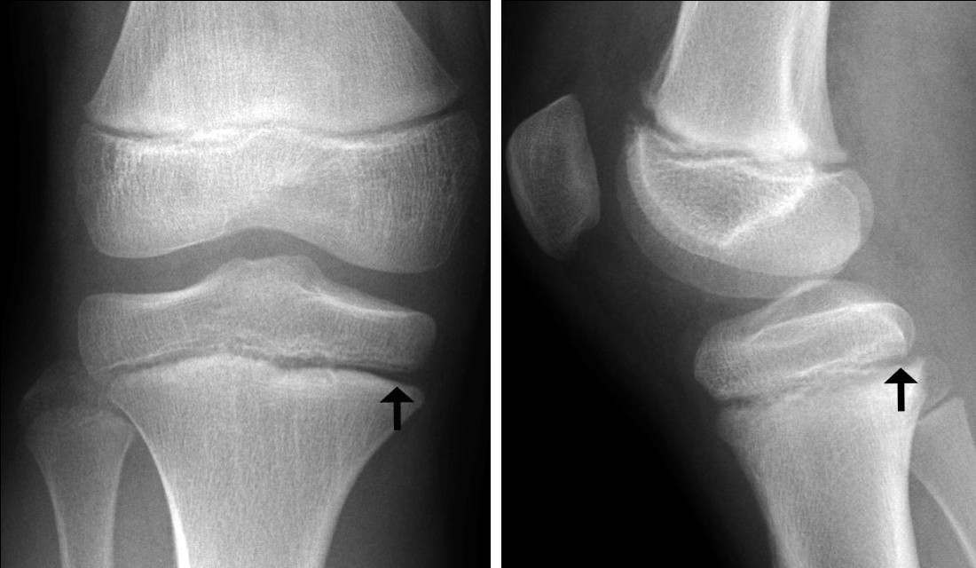 Figure 1: Non-displaced fracture of the proximal tibial physis. Initial anteroposterior (a) and lateral (b). radiographs following trauma show subtle asymmetric widening of the posteromedial physis (arrows), but no displacement.