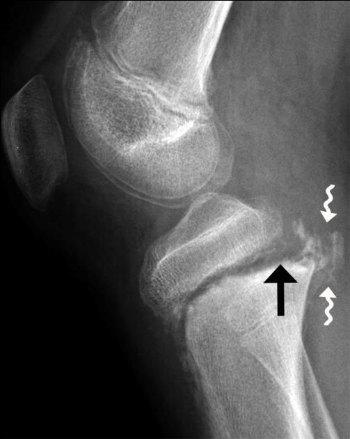 Figure 2: Fracture displacement with periosteum interposition. Lateral radiograph (a) shows new posterior displacement and physeal widening (arrow). Note the surrounding healing response (wiggly arrows). Subsequent sagittal T2-weighted magnetic resonance (MR) image (b) at the level of the intercondylar notch shows interposition of periosteum (arrowheads). PCL = posterior cruciate ligament.