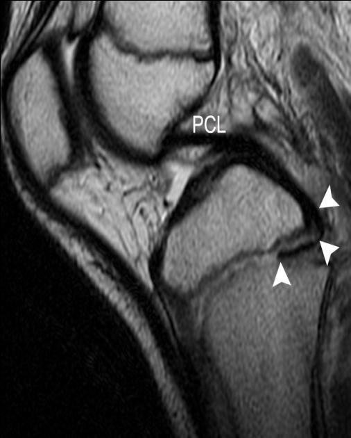 Figure 3: Healed fracture without osseous transphyseal bar. Coronal (a) and sagittal (b) computed tomography (CT) images show physeal irregularity (brackets), but no interval development of an osseous bar. Note the slightly asymmetrically faster growth across the medial proximal tibial physis relative to the lateral physis, which led to the clinically observed valgus deformity.