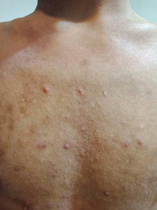 Figure 1: Abscesses on his chest.