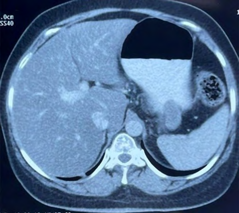 Figure 1: CT showing the gastric GIST.