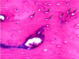 Figure 2: Osseous choristoma exhibiting foci of mature bone imbued with osteocytes and a normal Haversian system [9].