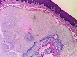 Figure 3: Osseous choristoma exemplifying foci of mature cartilage and bone admixed with a fibrous tissue stroma and a superimposed unremarkable stratified squamous epithelium [10].
