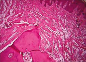 Figure 4: Osseous choristoma depicting mature bone with an intact Haversian canal system and commingled fibrous tissue [11].