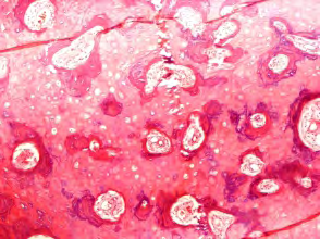 Figure 5: Osseous choristoma enunciating foci of mature bone, cartilaginous tissue, patent Haversian canals and intermingled fibrous tissue [12].