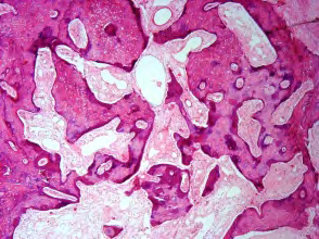 Figure 6: Osseous choristoma displaying Haversian canals with osteocytes, mature bone and circumscribing fibrous tissue stroma [12].