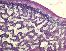 Figure 7: Osseous choristoma demonstrating a lace-like pattern of mature bone, admixed fibrous tissue and a superimposed, unremarkable fibrous tissue stroma [13].