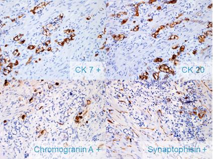 Figure 3: Goblet cells stain for CK 20 and CK7, and show focal immunoreactivity for chromogranin and synaptophysin.