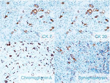 Figure 6: Tumoral cells display positive immunoreactivity for cytokeratin 20 and cytokeratin 7, and focally or endocrine markers (chromogranin A and synaptophysin).