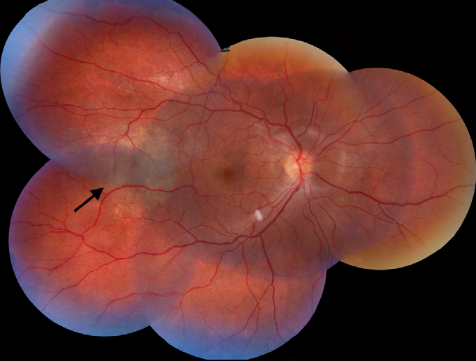 Figure 1: Fundus photography OD revealed a yellowish placoid-like lesion temporal to the fovea (black arrow) and a serous retinal detachment.