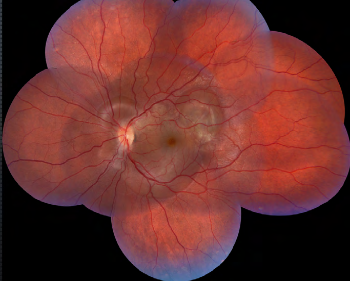 Figure 2: Fundus photography OS revealed multiple serous retinal detachments.