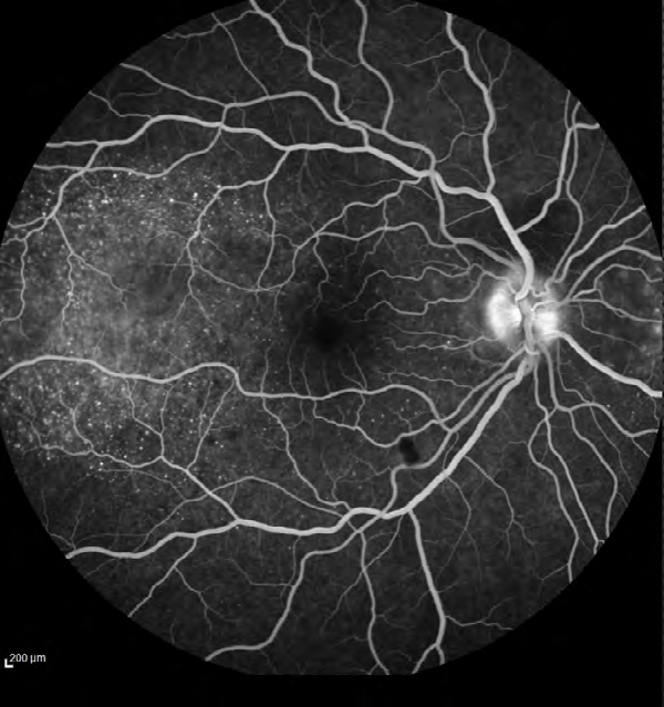 Figure 3: FA showed areas of pinpoint leakage and staining of the optic disk.