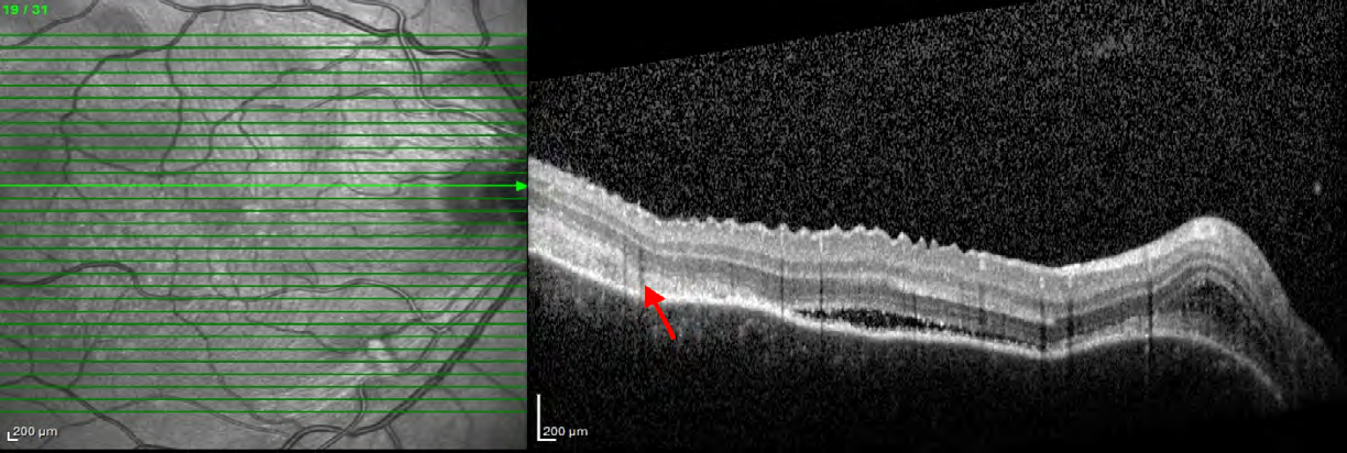 Figure 5: OCT OS showed cells in the vitreoretinal interface and serous macular detachment.