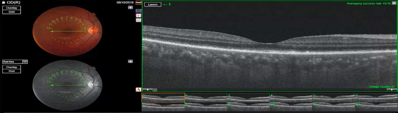 Figure 7: OCT OS showed complete improvement of the serous retinal detachment and some irregularities at the level of RPE/ Bruch Membrane complex.